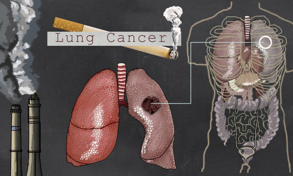 Lung Cancer illustrated in classic Style