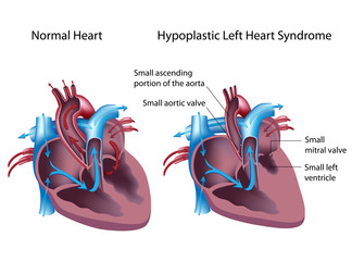 Hypoplastic left heart syndrome
