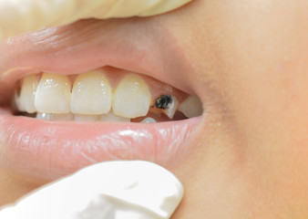 Broken teeth and Limestone stains and food stains in children teeth