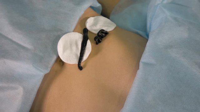 Two squirming leeches lying on womans abdomen in close view. 4K.