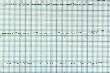 Heart analysis, electrocardiogram graph (ECG)