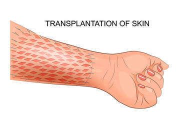 transplantation of skin. plastic surgery - obrazy, fototapety, plakaty