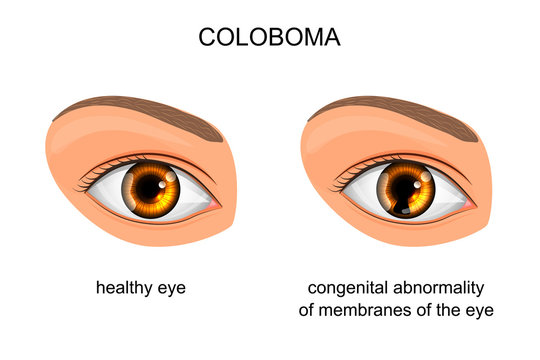 congenital disorder of membranes of the eye. coloboma