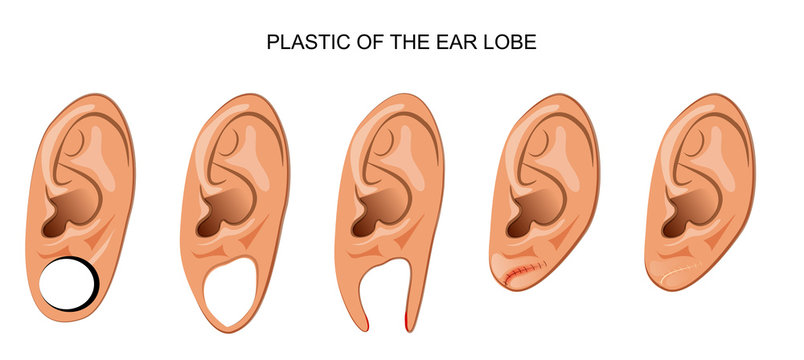 plastic ear after ear tunnel