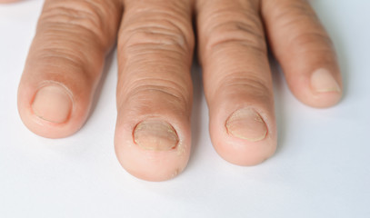 Fungus on fingers