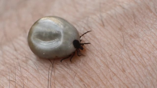 Tick filled with blood sitting on human skin