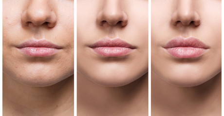 Lips of young woman before and after augmentation - 168732985