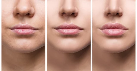 Fotobehang Lips of young woman before and after augmentation © Dmitrii Kotin