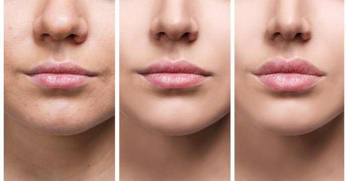 368 BEST Lip Filler Before And After IMAGES, STOCK PHOTOS &amp; VECTORS | Adobe  Stock