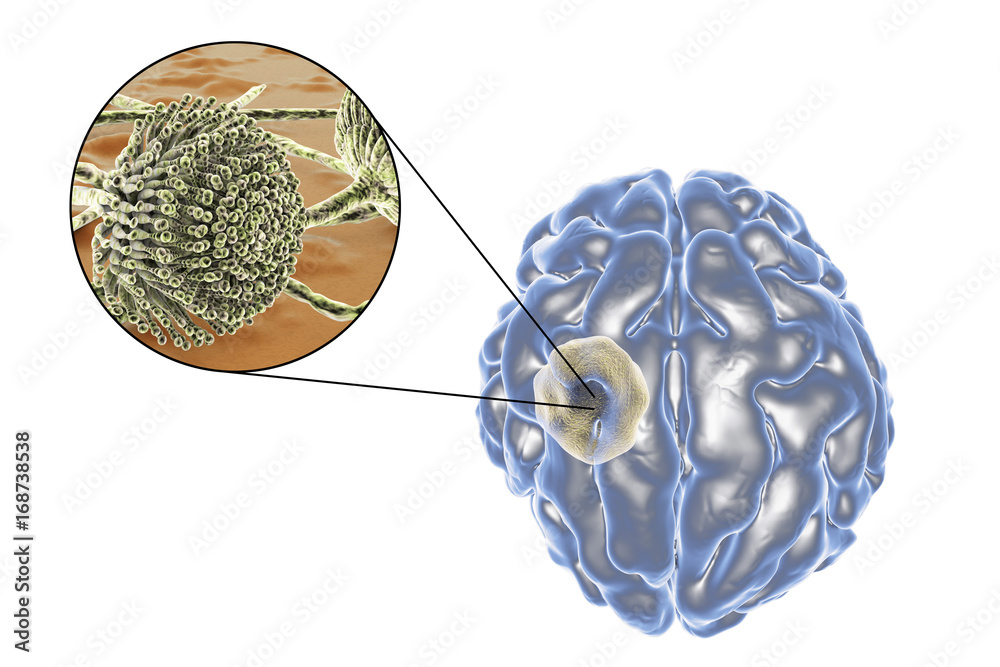 Wall mural Aspergilloma of the brain and close-up view of fungi Aspergillus, 3D illustration. An intracranial lesion produced by fungi Aspergillus in immunocompromised patients