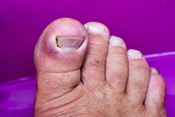 Toe disease