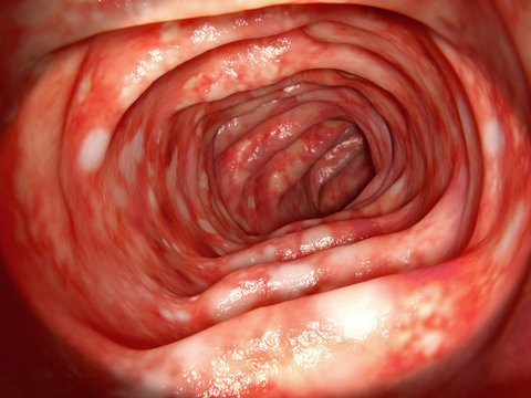 Colitis ulcerosa. Sie ist eine chronisch-entzündliche Darmerkrankung