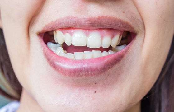 ugly smile dental problem. Teeth Injuries or Teeth Falling in female. Trauma and Nerve Damage of injured tooth, Permanent Teeth Injury.