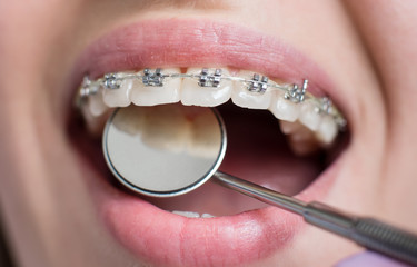 Macro shot of white teeth with braces. Smiling female patient with metal brackets at the dental office. Dentist holding mirror. Orthodontic Treatment.
