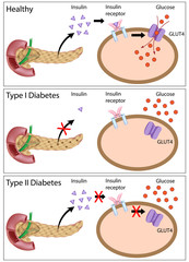 Insulin action and diabetes type 1 and 2
