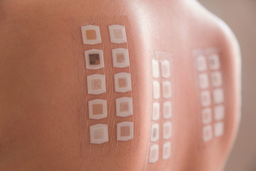 Alergy patch test on the back of a young woman