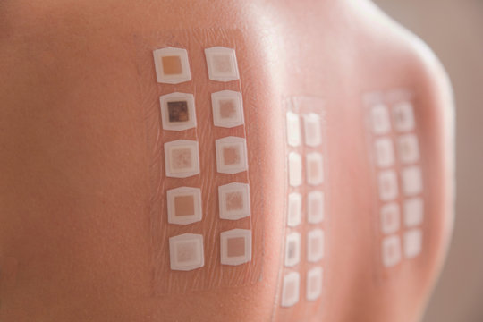 Alergy patch test on the back of a young woman
