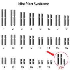 Klinefelter syndrome