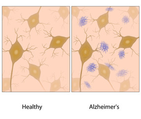 Alzheimer's disease brain tissue with amyloid