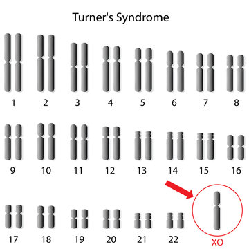 Monosomy X, Turner's syndrome