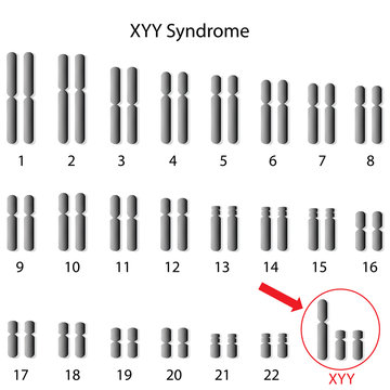 XYY, genome of the Super Male Syndrome 