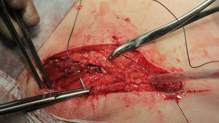 Surgeon stitches tissues after the surgery with special surgical thread close-up