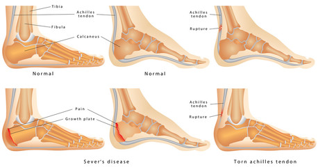 Ankle, Calcaneal Apophysitis, Achilles tendon