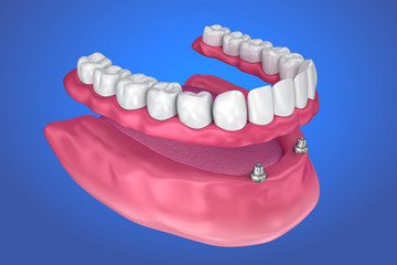 Overdenture to be seated on ball attachments. 3D illustration