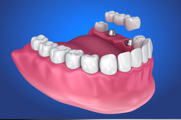 implant supported fixed bridge. Medically accurate 3D illustration