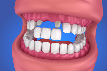 Tooth supported fixed bridge. Medically accurate 3D illustration