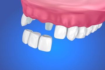 Tooth supported fixed bridge. Medically accurate 3D illustration