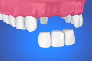Tooth supported fixed bridge. Medically accurate 3D illustration