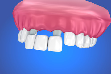 Tooth supported fixed bridge. Medically accurate 3D illustration
