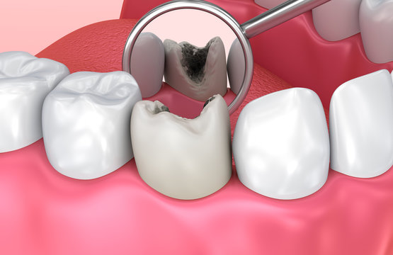 Teeth inspection with mirror. Medically accurate tooth 3D illustration