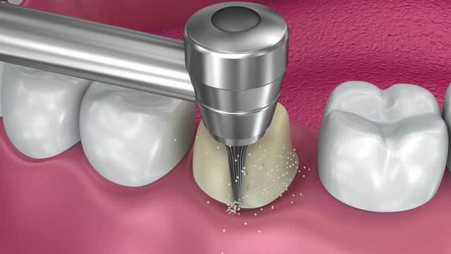 Dental crown installation process, Medically accurate 3d animation