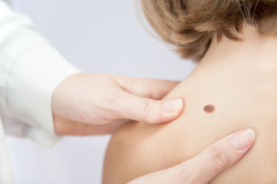 birthmark / A medical consultation at the Removal of nevus.
