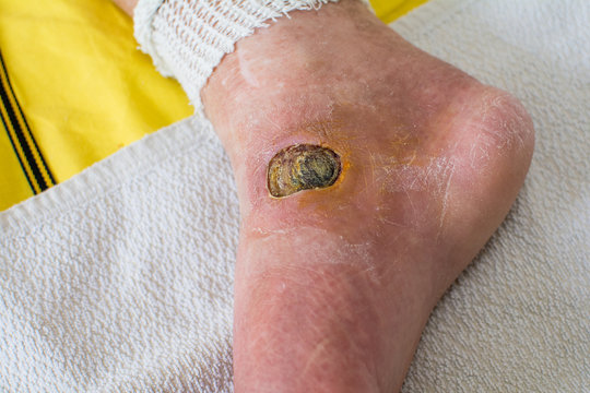 Diabetic Foot