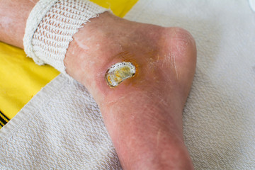 Diabetic Foot