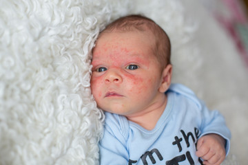 Little newborn baby sleeping, baby with scin rash © Tomsickova