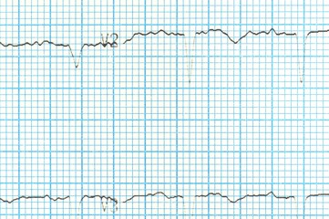 Heart analysis, electrocardiogram graph (ECG)