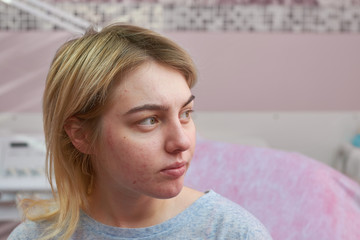 Caucasian girl with acne. Problematic face skin. Symptoms of allergic reaction.