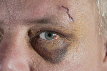 shiner black eye