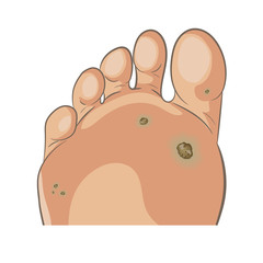 Foot wart. Foot bottom pathology: verruca, wart, papilloma virus. Many small warts on the sole and toe. Male or female sole, barefoot. Cartoon style, hand drawn.