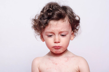 Portrait of a cute sick baby boy upset looking down to his spots. Adorable upset child with spots on his face and body form illness, mosquito bites, roseola, rubella, measles. - 169526110