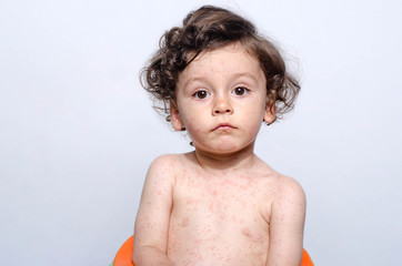 Portrait of a cute sick baby boy. Adorable upset child with spots on his face and body form illness, mosquito bites, roseola, rubella, measles.