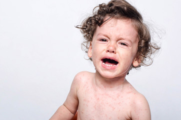 Portrait of a cute sick baby boy crying. Adorable upset child with spots on his face and body form illness, mosquito bites, roseola, rubella, measles. - obrazy, fototapety, plakaty