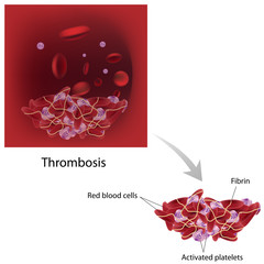 Structure of a thrombosis 