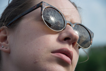Young woman in sunglasses with acne