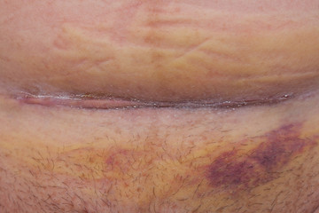 Fototapeta premium Cesarean scar