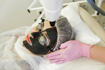 Procedure carbon peeling. Laser rejuvenation and skin lightening, treatment of problematic skin.